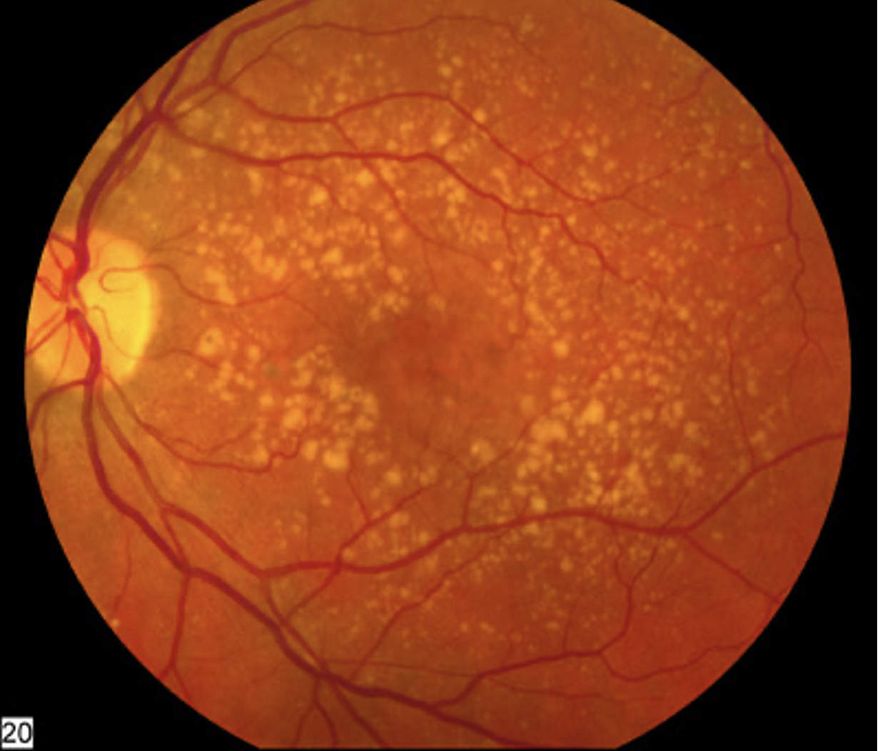 macular degeneration eye